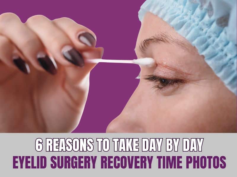 Day By Day Eyelid Surgery Recovery Time Photos