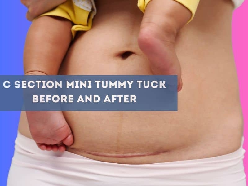 C Section Mini Tummy Tuck Before And After