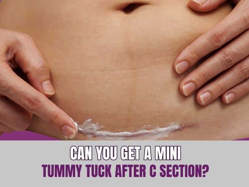 Can You Get a Mini Tummy Tuck After C Section