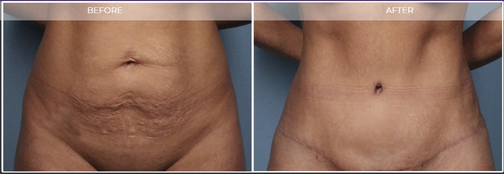 Candidate for mini tummy tuck