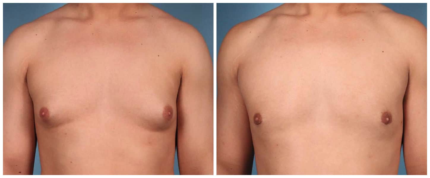 Causes of gynecomastia