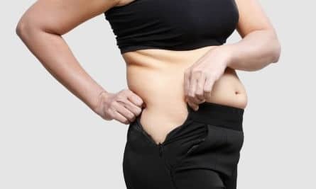 Tummy Tuck For Obese Patients
