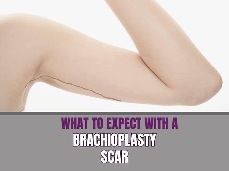 What to Expect with a Brachioplasty Scar