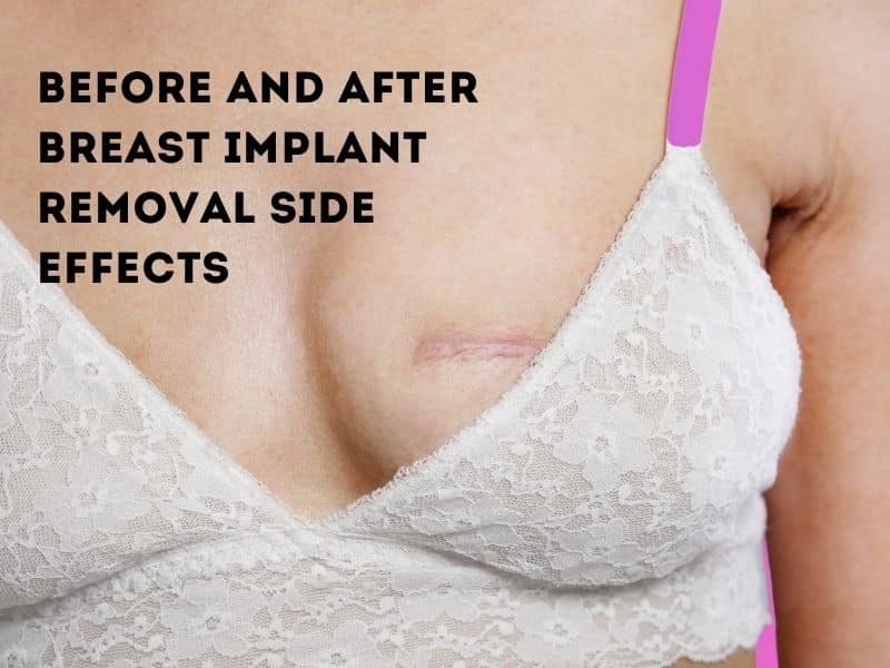 before and after breast implant removal side effects