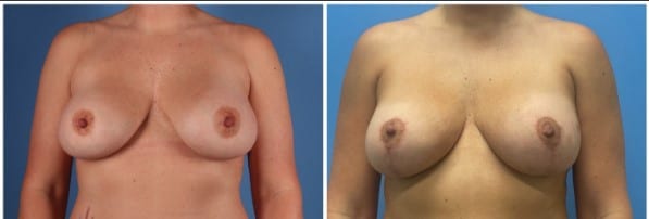 before and after breast lift