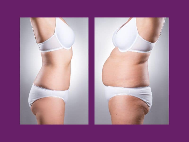 before and after mini tummy tuck results