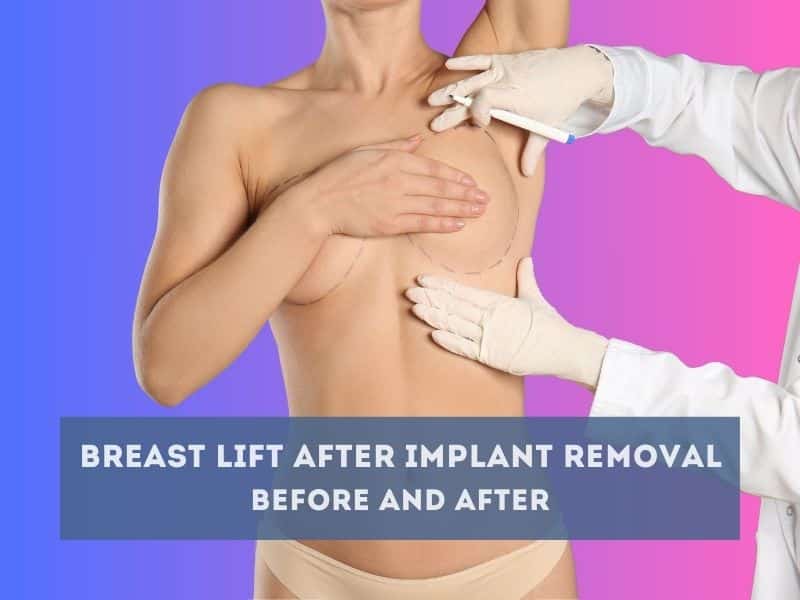 breast lift after implant removal before and after