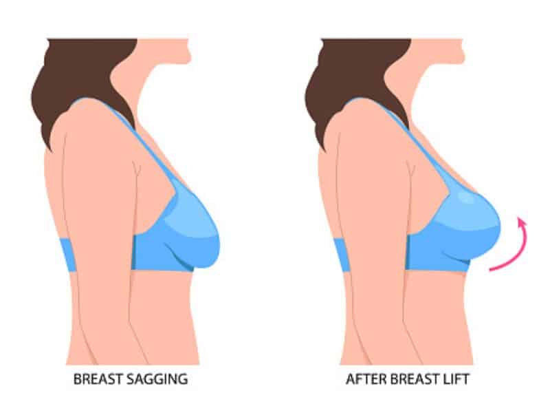 breast lift before and after without implant