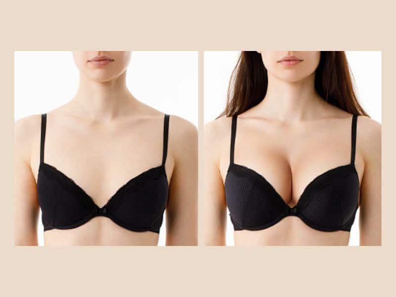 breast lift with fat transfer before and after 