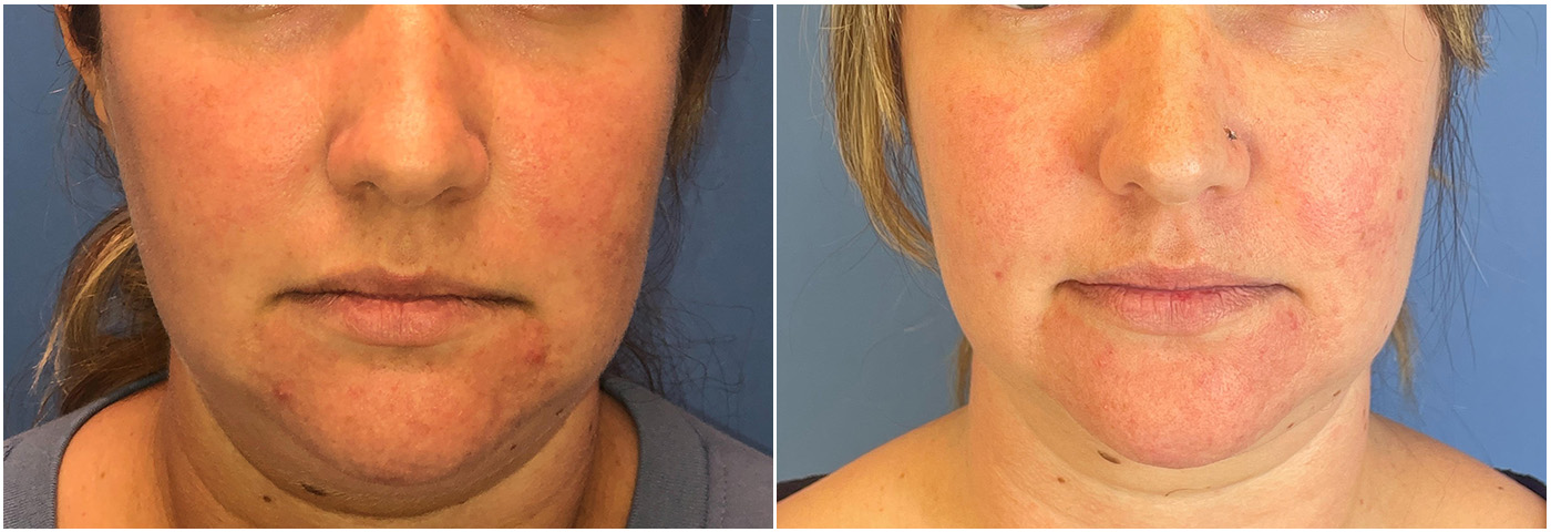 SBLA BEAUTY  Kathy J. before and after using our Neck, Chin