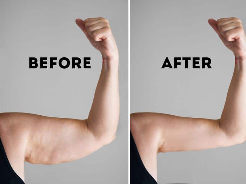 mini arm lift before and after