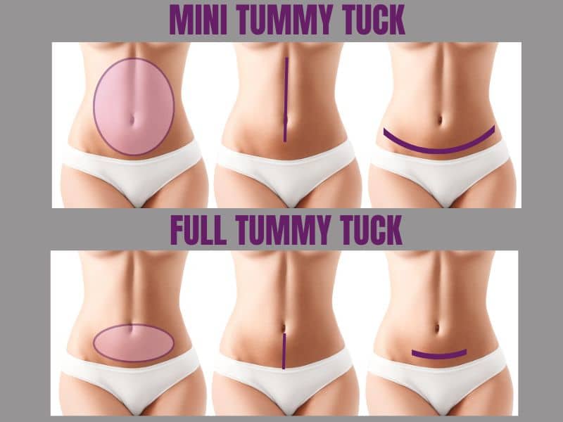  mini tummy tuck vs full tummy tuck pictures 