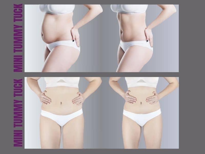 mini tummy tuck vs full