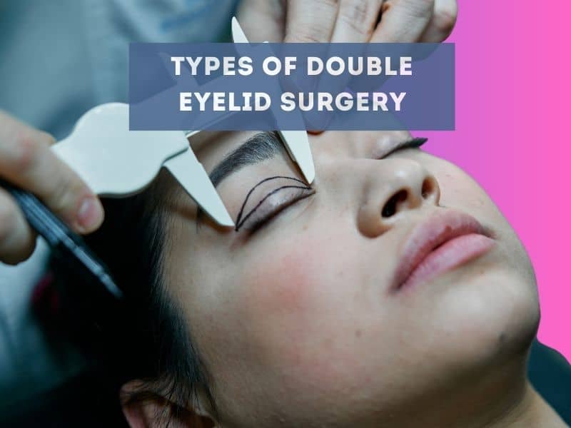 types of double eyelid surgery