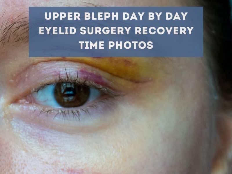 upper bleph day by day eyelid surgery recovery time photos