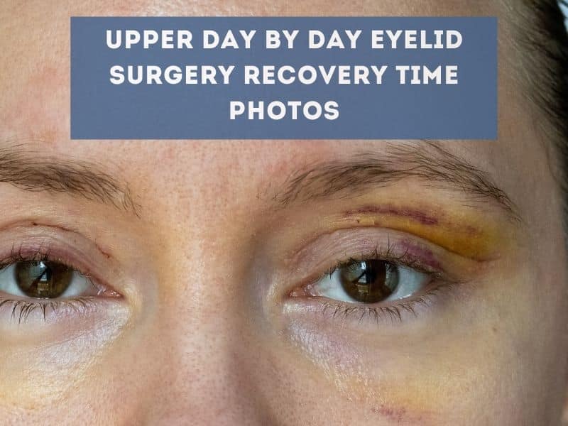 upper day by day eyelid surgery recovery time photos